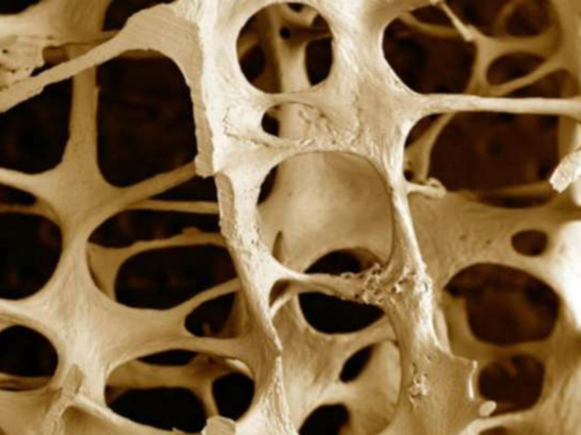 Osteoporosi, problema tipico dell'et&agrave; avanzata