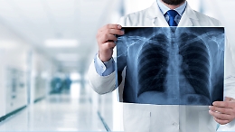 Emergenza coronavirus, bloccato l'accesso diretto alla radiologia dell'ospedale di Asti