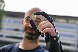 Soglio: la protesi bionica gli rid&agrave; l'uso della mano sinistra