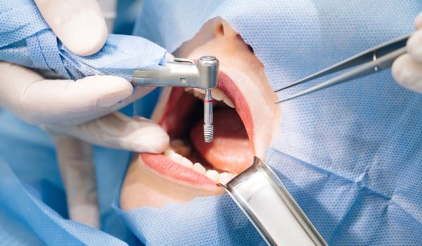 close up shot attentive doctors performing surgical operation installing dental implants into patient s mouth modern dental clinic