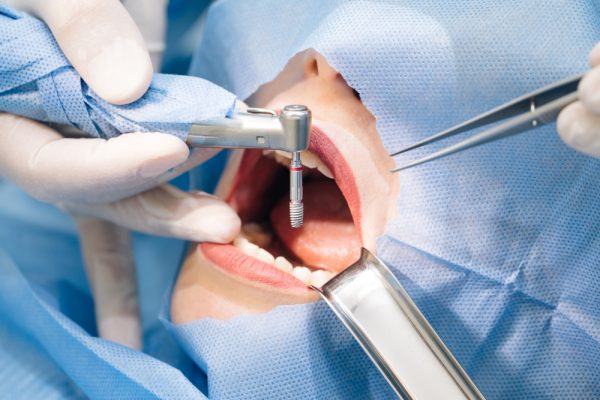 close up shot attentive doctors performing surgical operation installing dental implants into patient s mouth modern dental clinic