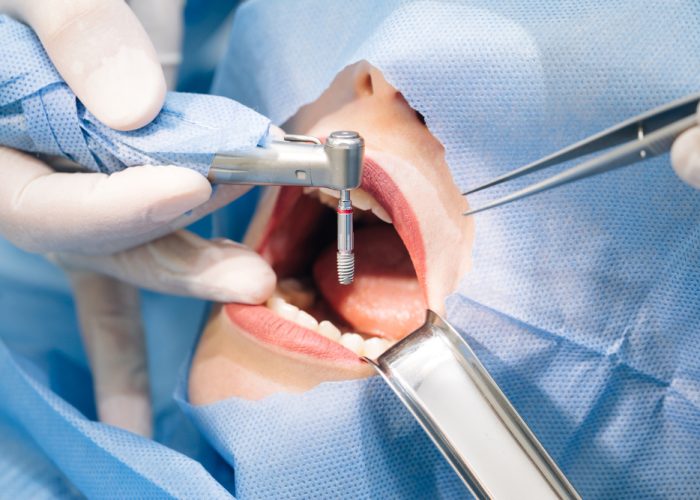 close up shot attentive doctors performing surgical operation installing dental implants into patient s mouth modern dental clinic