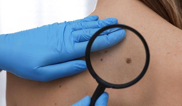 Dermatologist examining patient's birthmark with magnifying glas