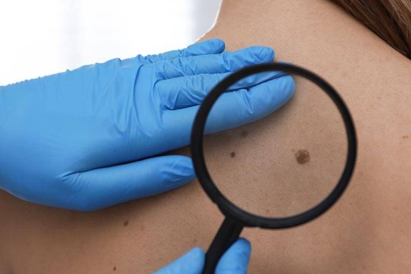 Dermatologist examining patient's birthmark with magnifying glas