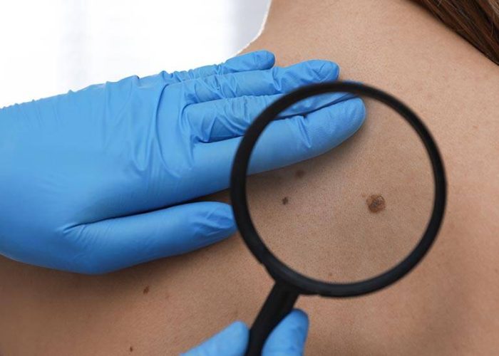 Dermatologist examining patient's birthmark with magnifying glas
