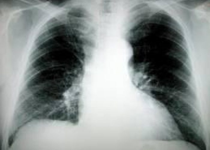 Medicina/ Cancro a polmone principale causa morte donne nel 2015
