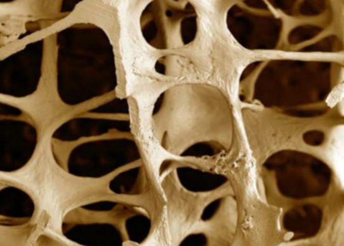 Osteoporosi, problema tipico dell'età avanzata